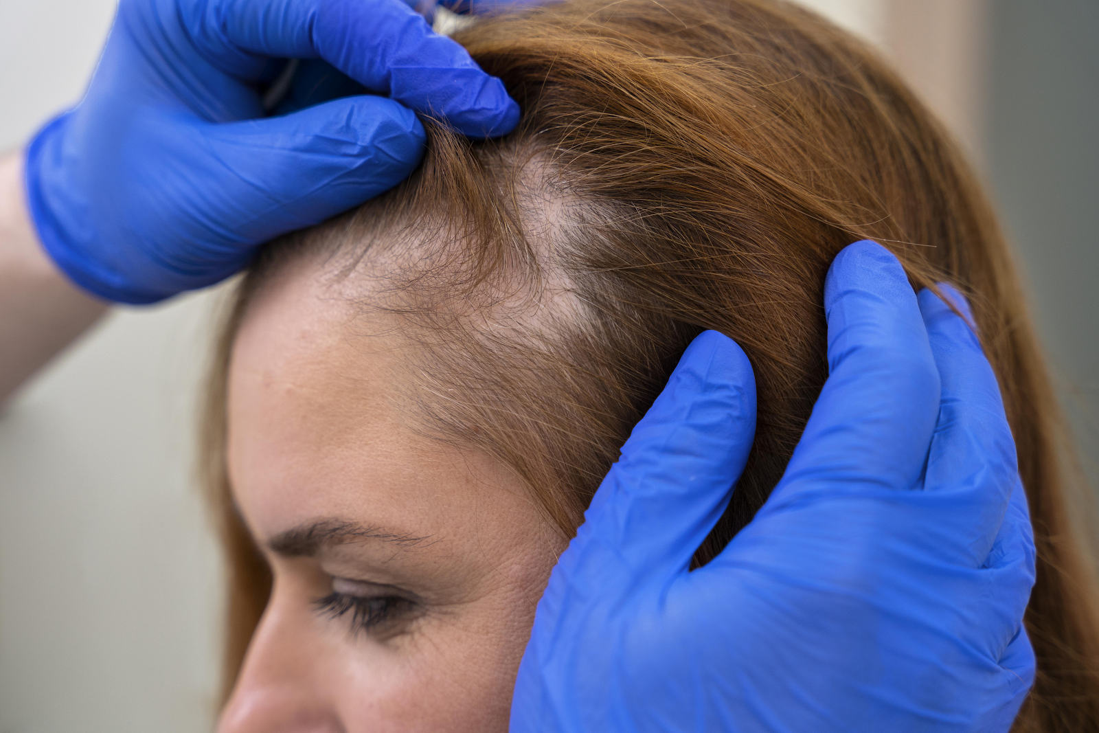 Hair Loss Treatment: What You Need to Know