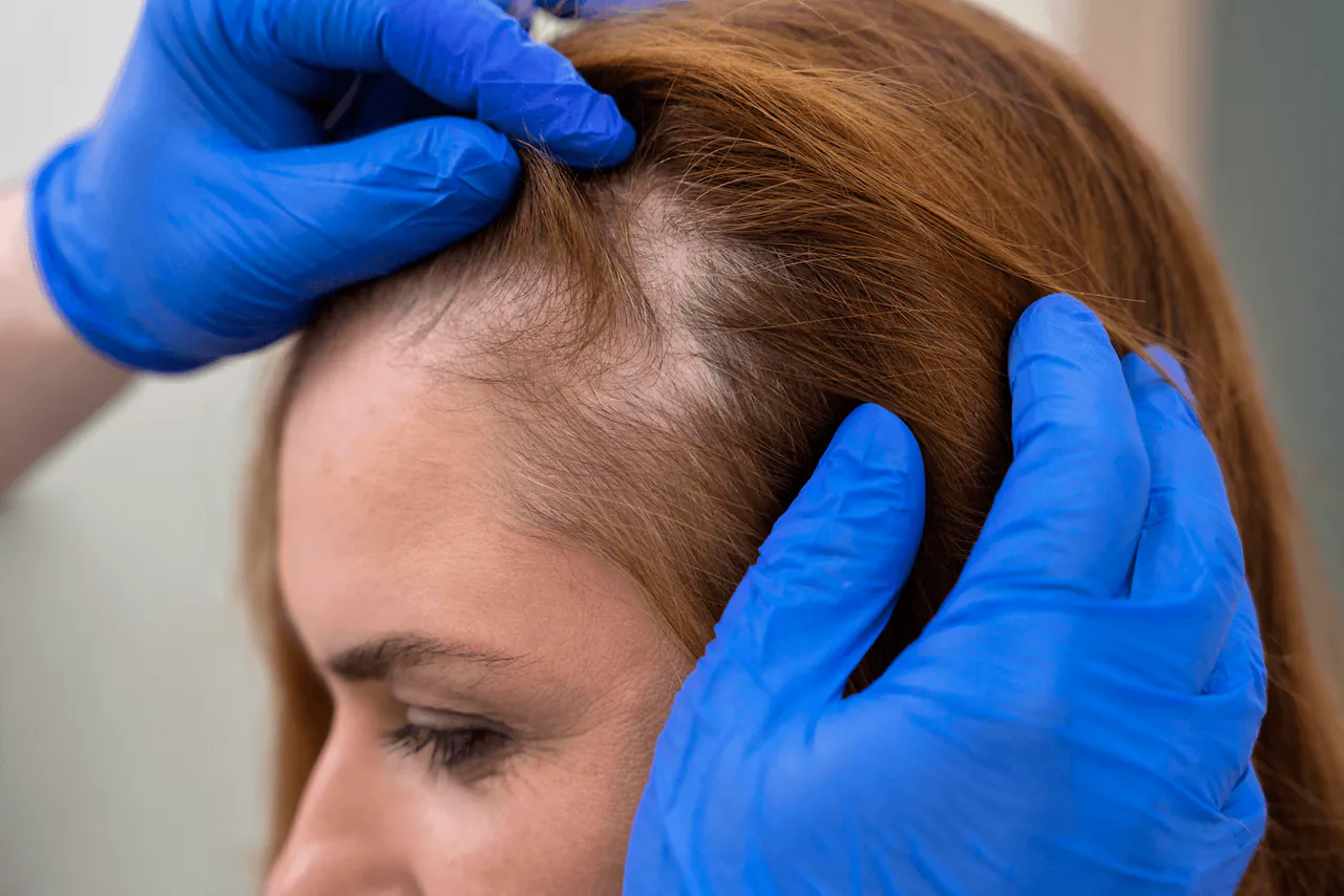 Hair Loss Treatment: What You Need to Know